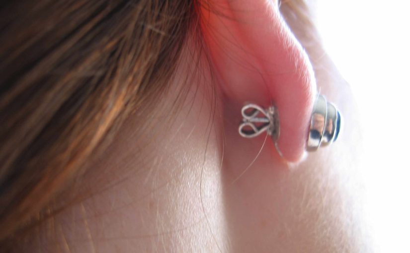 A Lobe Lift for Droopy Earlobes
